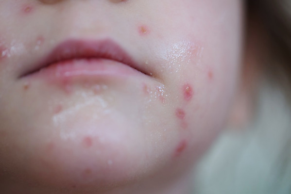 포토 JPG 해외이미지 어린이 신체 건강 사람 사람없음 빨간색 치킨 고통 아기 바이러스 닫기 질병 피부 오르기 감염 전염 몸통 문제 알레르기 두드러기 돌봄 반응 증상 해외202004 해외포토 감정 컬러 의학 모션 신체부위 닭고기요리 파일형식 이미지허브