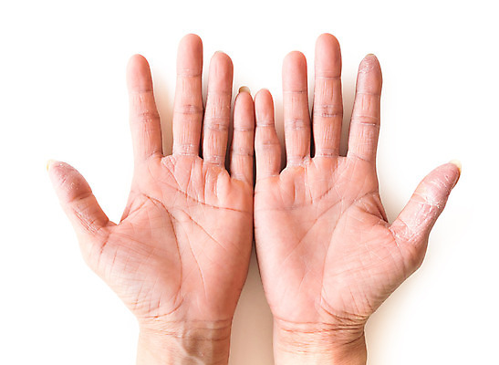 포토 JPG 해외이미지 백인 손 분홍색 백그라운드 신체 손가락 건조 건강 사람 사람없음 치료 빨간색 약 고통 환자 흰색 질병 상처 피부 묘사 질감 감염 알레르기 돌봄 반응 증상 못생김 해외202004 해외포토 서양인 감정 컬러 의학 모션 신체부위 파일형식 이미지허브