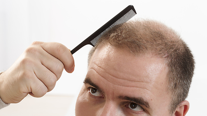 포토 JPG 해외이미지 백인 헤어스타일 남자 얼굴 수염 한명 사람 성인 치료 약 갈색 머리 활발 흰색 머리빗 점 중앙 정상 자르기 피부 대머리 돌봄 적자 스타일 해외202004 해외포토 서양인 1 컬러 컨셉 의학 모션 신체부위 미용용품 파일형식 이미지허브