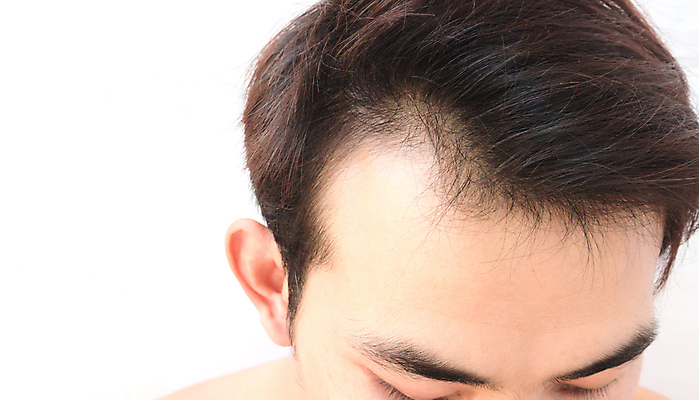 포토 JPG 해외이미지 남자 한명 근접촬영 성인 뷰티 머리카락 머리 흰배경 두피관리 두피케어 탈모 탈모클리닉 성인남자한명만 해외202004 탈모예방 숱 해외포토 1 뷰포인트 백그라운드 사람 신체부위 흰색 예방 클리닉 헤어관리 증상 남자한명만 성인남자만 파일형식 이미지허브