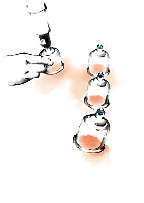 PSD 손 일러스트 캘리그라피 의학 두명 신체부위 치료 한의학 질병 한의원 부항 부항기 부황뜨기 국내일러스트 병원 사람 파일형식