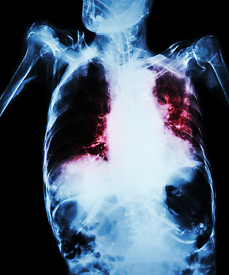 포토 JPG 해외이미지 신체 해부 뼈 골격 엑스레이 병원 사람없음 약 환자 의사 광선 비행 호흡기관 질병 X 흉부 감염 전염 시스템 튜브 갈비뼈 궤 돌봄 방사선 심각 염증 옛날 전염병 해외202004 해외포토 알파벳 컨셉 의학 모션 의료진 장기_의학 파일형식 이미지허브