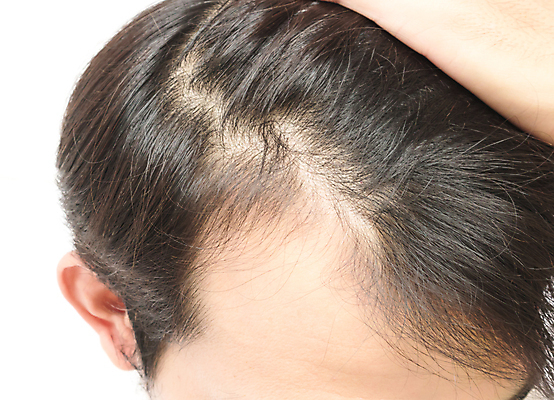 포토 JPG 해외이미지 남자 한명 근접촬영 성인 뷰티 머리카락 머리 흰배경 헤어관리 두피관리 두피케어 탈모 탈모클리닉 성인남자한명만 해외202004 탈모예방 숱 해외포토 1 뷰포인트 백그라운드 사람 신체부위 흰색 예방 클리닉 증상 남자한명만 성인남자만 파일형식 이미지허브