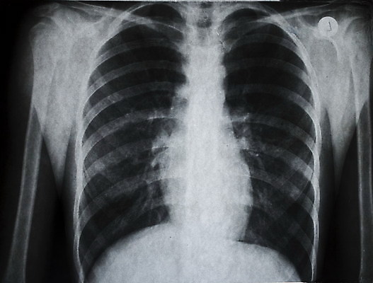 포토 JPG 해외이미지 신체 해부 뼈 골격 엑스레이 실내 건강 병원 사람 사람없음 약 광선 하트 투명 질병 X 척추 그림 빛망울 방사선 연골 해외202004 해외포토 모양 알파벳 의학 내부 빛 파일형식 이미지허브