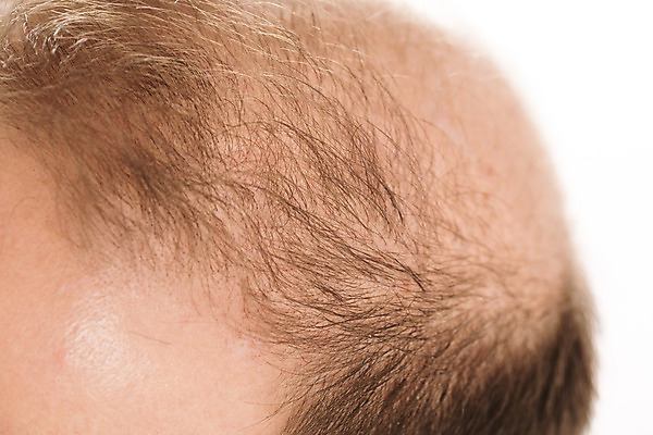 포토 JPG 해외이미지 백인 헤어스타일 남자 얼굴 과학 부분 수염 건강 사람 성인 사람없음 치료 약 갈색 머리 활발 흰색 머리빗 점 질병 정상 자르기 피부 대머리 돌봄 적자 스타일 해외202004 해외포토 서양인 컬러 컨셉 의학 모션 신체부위 미용용품 파일형식 이미지허브