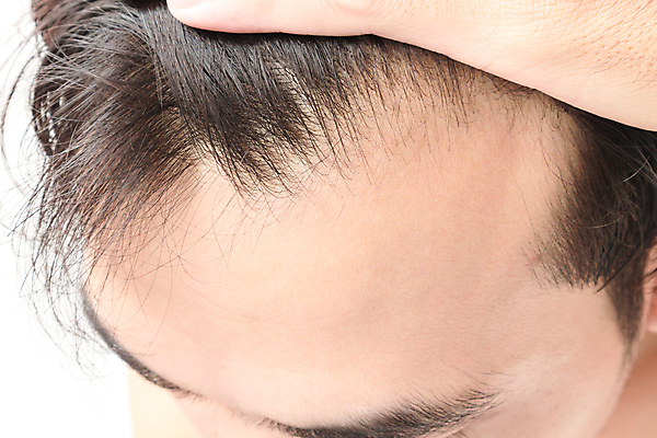 포토 JPG 해외이미지 남자 한명 근접촬영 상반신 성인 뷰티 머리카락 머리 흰배경 헤어관리 두피관리 두피케어 탈모 탈모클리닉 성인남자한명만 해외202004 탈모예방 숱 해외포토 1 뷰포인트 백그라운드 사람 신체부위 흰색 예방 클리닉 증상 남자한명만 성인남자만 파일형식 이미지허브