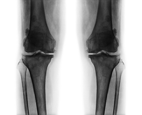 포토 JPG 해외이미지 백그라운드 해부 뼈 엑스레이 성인 사람없음 검은색 고통 환자 광선 흰색 질병 X 필름 관절염 좁은 무릎 골다공증 외과 허벅지 고립 돌봄 방사선 연골 염증 옛날 정형외과 해외202004 해외포토 알파벳 감정 컬러 의학 모션 병원 사람 신체부위 파일형식 이미지허브