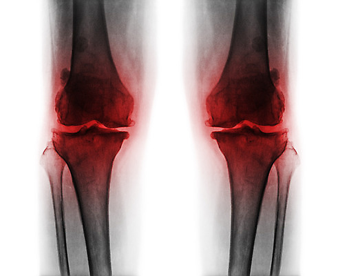 포토 JPG 해외이미지 백그라운드 해부 뼈 엑스레이 성인 사람없음 검은색 고통 환자 광선 흰색 질병 X 필름 관절염 좁은 무릎 골다공증 외과 허벅지 고립 돌봄 방사선 연골 염증 옛날 정형외과 해외202004 해외포토 알파벳 감정 컬러 의학 모션 병원 사람 신체부위 파일형식 이미지허브