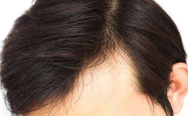 포토 JPG 해외이미지 남자 한명 근접촬영 성인 뷰티 머리카락 머리 흰배경 헤어관리 두피관리 두피케어 탈모 탈모클리닉 성인남자한명만 해외202004 탈모예방 숱 해외포토 1 뷰포인트 백그라운드 사람 신체부위 흰색 예방 클리닉 증상 남자한명만 성인남자만 파일형식 이미지허브