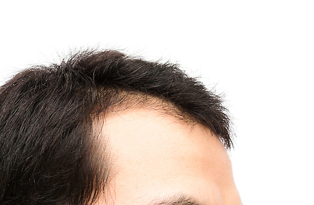 포토 JPG 해외이미지 남자 한명 근접촬영 성인 뷰티 머리카락 머리 흰배경 헤어관리 두피관리 두피케어 탈모 탈모클리닉 성인남자한명만 해외202004 탈모예방 숱 해외포토 1 뷰포인트 백그라운드 사람 신체부위 흰색 예방 클리닉 증상 남자한명만 성인남자만 파일형식 이미지허브