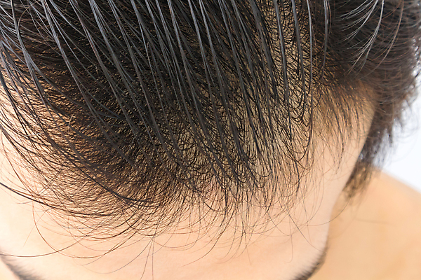 포토 JPG 해외이미지 남자 한명 근접촬영 성인 뷰티 머리카락 머리 흰배경 헤어관리 두피관리 두피케어 탈모 탈모클리닉 성인남자한명만 해외202004 탈모예방 숱 해외포토 1 뷰포인트 백그라운드 사람 신체부위 흰색 예방 클리닉 증상 남자한명만 성인남자만 파일형식 이미지허브