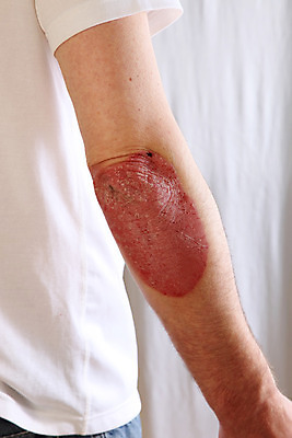 포토 JPG 해외이미지 부분 건강 사람 사람없음 고통 환자 질병 피부 피부관리 팔 염증 유전 증상 팔꿈치 해외202004 해외포토 감정 의학 신체부위 뷰티 파일형식 이미지허브