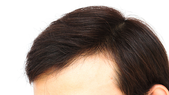 포토 JPG 해외이미지 남자 한명 근접촬영 성인 뷰티 머리카락 머리 흰배경 헤어관리 두피관리 두피케어 탈모 탈모클리닉 성인남자한명만 해외202004 탈모예방 숱 해외포토 1 뷰포인트 백그라운드 사람 신체부위 흰색 예방 클리닉 증상 남자한명만 성인남자만 파일형식 이미지허브