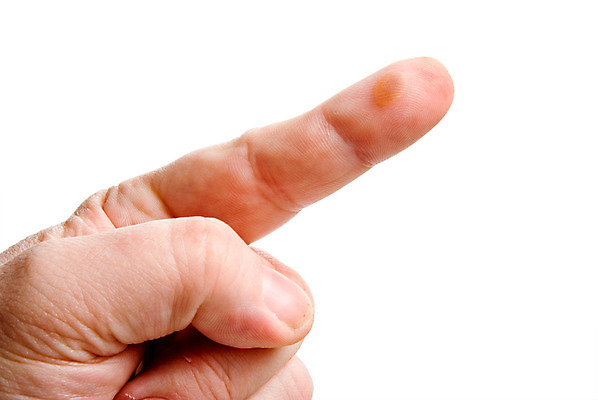 포토 JPG 해외이미지 손 신체 손가락 건강 사람 사람없음 약 건강관리 거품 고통 끝 닫기 묘사 질감 끓이기 돌봄 화상 해외202004 해외포토 감정 의학 모션 관리 신체부위 상처 파일형식 이미지허브