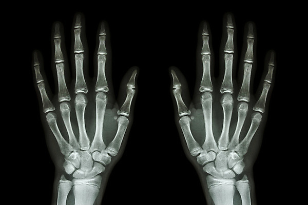 포토 JPG 해외이미지 손 신체 손가락 해부 뼈 골격 엑스레이 건강 병원 손바닥 사람 사람없음 숫자 약 검은색 고통 환자 의사 광선 흰색 쌍 오르간 X 손목 생물학 외과 고립 돌봄 방사선 정형외과 해외202004 해외포토 문자 알파벳 교육 감정 컬러 의학 모션 신체부위 의료진 건반악기 파일형식 이미지허브