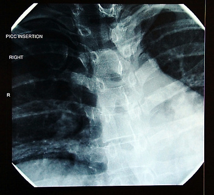 포토 JPG 해외이미지 여자 선 엑스레이 병원 사람없음 하트 척추 정맥 바비큐립 순서 궤 마지막 방사선 해외202004 해외포토 모양 의학 뼈 사람 바비큐 혈관 파일형식 이미지허브