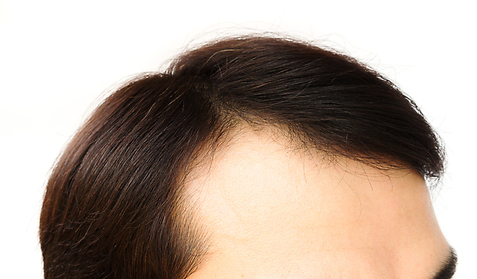 포토 JPG 해외이미지 남자 한명 근접촬영 성인 뷰티 머리카락 머리 흰배경 헤어관리 두피관리 두피케어 탈모 탈모클리닉 성인남자한명만 해외202004 탈모예방 숱 해외포토 1 뷰포인트 백그라운드 사람 신체부위 흰색 예방 클리닉 증상 남자한명만 성인남자만 파일형식 이미지허브