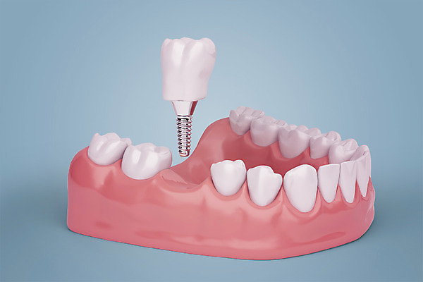 PSD 편집이미지 치과 사람없음 3D소스 3D 치아 디지털합성 합성 치아모형 나사못 임플란트 잇몸 치아건강 편집3D 신체 건강 병원 못 소화기관 파일형식