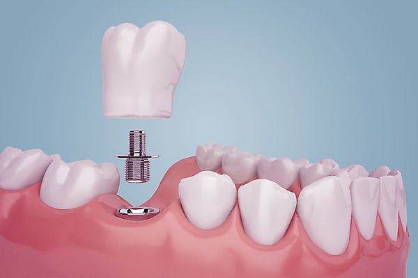 PSD 편집이미지 치과 사람없음 3D소스 3D 치아 디지털합성 합성 치아모형 나사못 임플란트 잇몸 치아건강 편집3D 신체 건강 병원 못 소화기관 파일형식