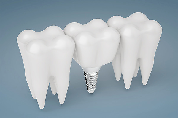 PSD 편집이미지 치과 사람없음 3D소스 3D 치아 디지털합성 합성 치아모형 나사못 임플란트 치아건강 편집3D 건강 병원 못 소화기관 파일형식