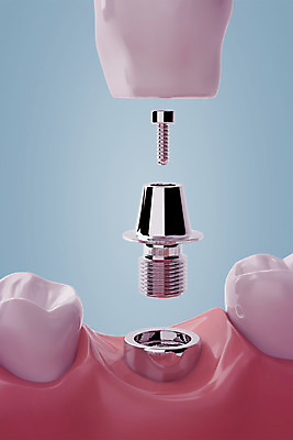 PSD 편집이미지 치과 사람없음 3D소스 3D 치아 디지털합성 합성 치아모형 나사못 임플란트 잇몸 치아건강 편집3D 신체 건강 병원 못 소화기관 파일형식