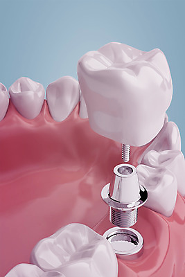 PSD 편집이미지 치과 사람없음 3D소스 3D 치아 디지털합성 합성 치아모형 나사못 임플란트 잇몸 치아건강 편집3D 신체 건강 병원 못 소화기관 파일형식