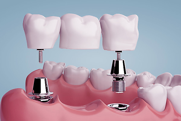 PSD 편집이미지 치과 사람없음 3D소스 3D 치아 디지털합성 합성 치아모형 나사못 임플란트 잇몸 치아건강 편집3D 신체 건강 병원 못 소화기관 파일형식