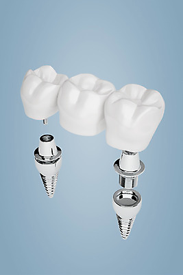 PSD 편집이미지 치과 사람없음 3D소스 3D 치아 디지털합성 합성 치아모형 나사못 임플란트 치아건강 편집3D 건강 병원 못 소화기관 파일형식