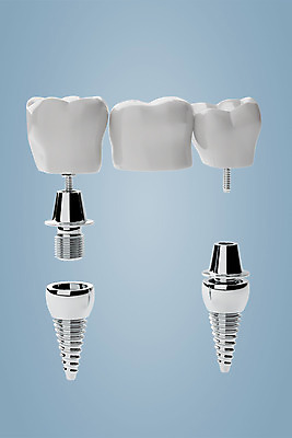 PSD 편집이미지 치과 사람없음 3D소스 3D 치아 디지털합성 합성 치아모형 나사못 임플란트 치아건강 편집3D 건강 병원 못 소화기관 파일형식