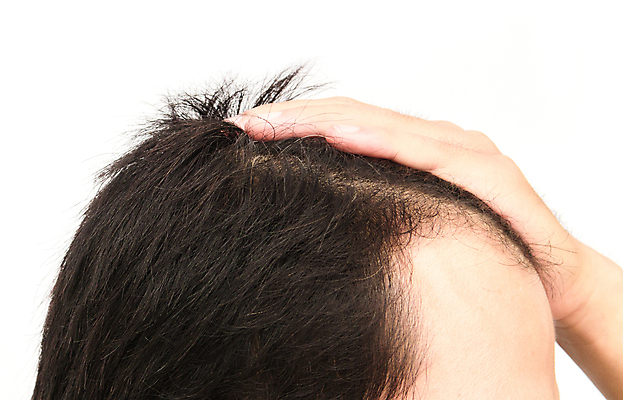 포토 JPG 해외이미지 손 남자 한명 근접촬영 성인 신체부위 뷰티 머리카락 머리 흰배경 헤어관리 감싸기 두피관리 두피케어 탈모 탈모클리닉 성인남자한명만 해외202004 탈모예방 숱 해외포토 1 뷰포인트 백그라운드 모션 사람 흰색 예방 클리닉 증상 남자한명만 성인남자만 파일형식 이미지허브