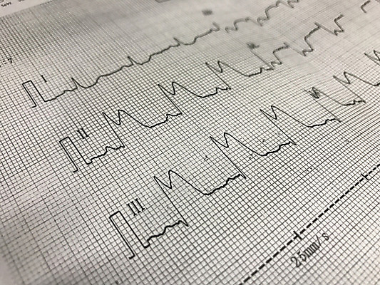 포토 JPG 해외이미지 교육 종이 파도 과학 백그라운드 컨셉 그래프 건강 사람없음 그래픽 치료 약 검은색 회색 하트 맥박 질병 위험 공격 뇌 문서 동맥 돌봄 심장병 심전도 해외202004 해외포토 모양 바다 컬러 의학 모션 혈관 파일형식 이미지허브