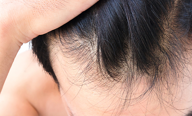 포토 JPG 해외이미지 남자 한명 근접촬영 성인 뷰티 머리카락 머리 흰배경 헤어관리 두피관리 두피케어 탈모 탈모클리닉 성인남자한명만 해외202004 탈모예방 숱 해외포토 1 뷰포인트 백그라운드 사람 신체부위 흰색 예방 클리닉 증상 남자한명만 성인남자만 파일형식 이미지허브