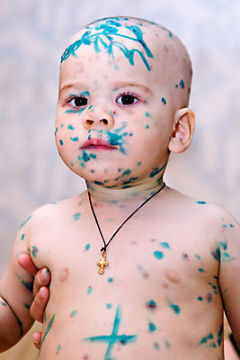 포토 JPG 해외이미지 어린이 한명 약 환자 열 바이러스 질병 치유 해외202004 해외포토 1 의학 사람 파일형식 이미지허브