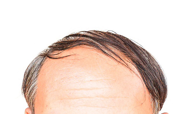 포토 JPG 해외이미지 노년 남자 한명 근접촬영 뷰티 머리카락 머리 흰배경 헤어관리 두피관리 두피케어 탈모 탈모클리닉 노인남자한명만 해외202004 탈모예방 해외포토 1 뷰포인트 백그라운드 사람 성인 신체부위 흰색 예방 클리닉 증상 남자한명만 노인남자만 파일형식 이미지허브