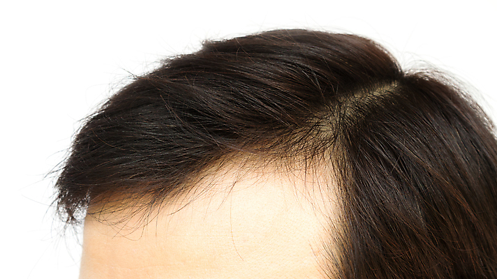 포토 JPG 해외이미지 남자 한명 근접촬영 성인 뷰티 머리카락 머리 흰배경 헤어관리 두피관리 두피케어 탈모 탈모클리닉 성인남자한명만 해외202004 탈모예방 해외포토 1 뷰포인트 백그라운드 사람 신체부위 흰색 예방 클리닉 증상 남자한명만 성인남자만 파일형식 이미지허브