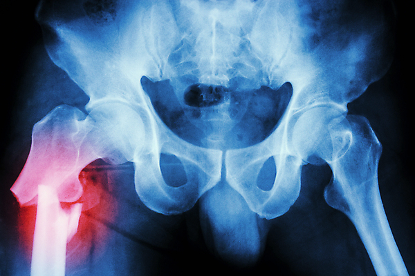 포토 JPG 해외이미지 과학 백그라운드 해부 바닥 뼈 골격 엑스레이 건강 병원 사람 사람없음 파란색 약 검은색 고통 시험 환자 의사 광선 X 엉덩이 사건 필름 당나귀 허벅지 골절 깨짐 방사선 정형외과 해외202004 해외포토 알파벳 교육 감정 컬러 컨셉 의학 신체부위 의료진 말_동물 파일형식 이미지허브