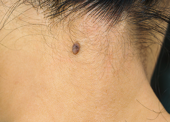 포토 JPG 해외이미지 여자 남자 백그라운드 신체 건강 병원 사람 동양인 성인 사람없음 치료 약 갈색 검은색 화장품 환자 의사 점 수술 피부 흔적 질감 문제 암 외과 삭제 돌봄 두더지 해외202004 해외포토 컬러 의학 모션 인종 신체부위 뷰티 의료진 질병 파일형식 이미지허브