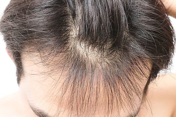 포토 JPG 해외이미지 남자 한명 근접촬영 성인 뷰티 머리카락 머리 흰배경 헤어관리 두피관리 두피케어 탈모 탈모클리닉 성인남자한명만 해외202004 탈모예방 숱 해외포토 1 뷰포인트 백그라운드 사람 신체부위 흰색 예방 클리닉 증상 남자한명만 성인남자만 파일형식 이미지허브