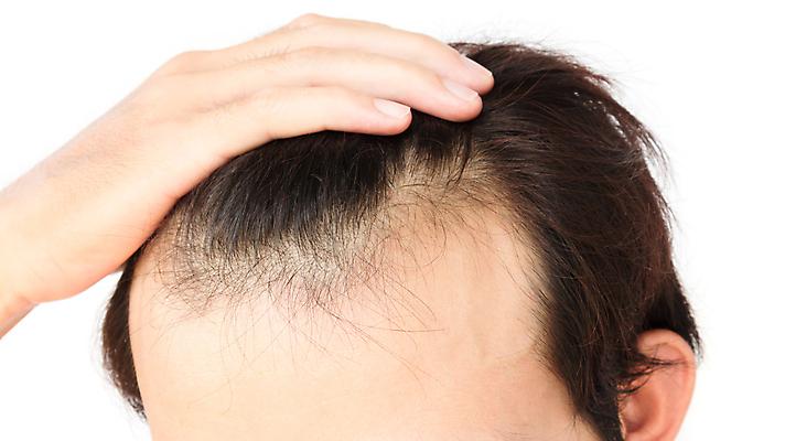 포토 JPG 해외이미지 손 남자 한명 근접촬영 성인 신체부위 뷰티 머리카락 머리 흰배경 헤어관리 감싸기 두피관리 두피케어 탈모 탈모클리닉 성인남자한명만 해외202004 탈모예방 숱 해외포토 1 뷰포인트 백그라운드 모션 사람 흰색 예방 클리닉 증상 남자한명만 성인남자만 파일형식 이미지허브