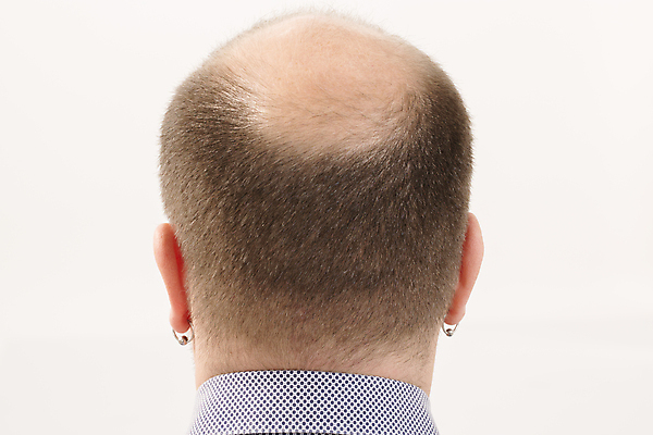 포토 JPG 해외이미지 백인 헤어스타일 남자 얼굴 수염 한명 사람 성인 치료 약 갈색 머리 활발 흰색 점 중앙 정상 자르기 피부 대머리 돌봄 적자 스타일 해외202004 해외포토 서양인 1 컬러 컨셉 의학 모션 신체부위 파일형식 이미지허브