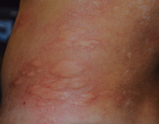 포토 JPG 해외이미지 곤충 표면 건조 건강 육류 사람 사람없음 옆모습 빨간색 약 검은색 어둠 고통 원형 바이러스 닫기 질병 상처 위험 무서움 피부 크림 묘사 전염 보여주기 찌르기 알레르기 두드러기 돌봄 반응 염증 주목 증상 못생김 해외포토 도형 동물 감정 뷰포인트 컬러 컨셉 식재료 의학 모션 신체부위 감염 파일형식 이미지허브