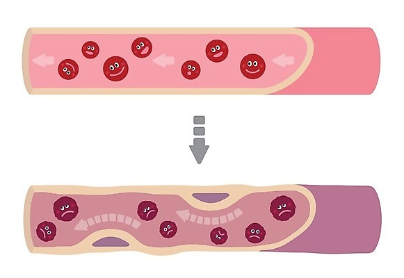 EPS 해외이미지 화살표 일러스트 의학 건강 웃음 사람없음 찡그림 질병 혈관 혈액순환 적혈구 동맥경화 해외일러스트 표정 장기_의학 혈구 파일형식 벡터 이미지허브