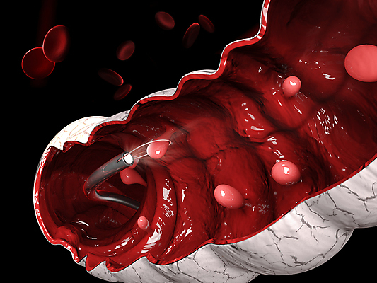 포토 JPG 해외이미지 해부 병원 사람 사람없음 치료 의사 조직 던지기 질병 자르기 속도 철사 섬유 암 외과 테라피 삭제 염증 종양 증상 폴리곤 현재 해외포토 컨셉 의학 모션 뷰티 의료진 직물 파일형식 이미지허브