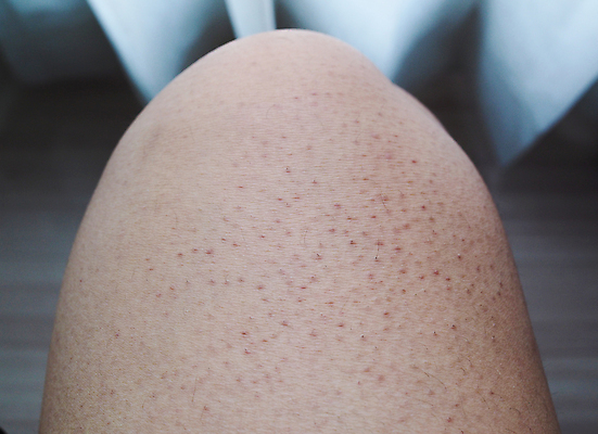 포토 JPG 해외이미지 백인 여자 백그라운드 패턴 신체 표면 추상 세포 건강 사람 성인 사람없음 약 어둠 성장 흰색 질병 큼 폭발 피부 묘사 질감 감염 암 내추럴 알레르기 곰팡이 돌봄 사춘기 염증 위생관리 해외포토 서양인 컬러 무늬 의학 모션 관리 신체부위 크기 파일형식 이미지허브