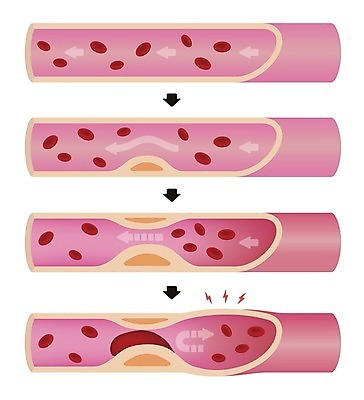 EPS 해외이미지 화살표 일러스트 의학 건강 사람없음 질병 혈관 적혈구 동맥경화 해외일러스트 장기_의학 혈구 파일형식 벡터 이미지허브