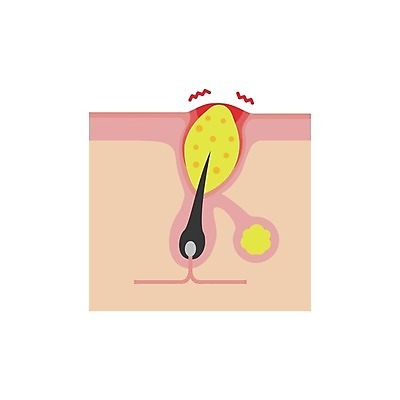 EPS 해외이미지 일러스트 의학 털 건강 사람없음 질병 피부 여드름 피부질환 모공 염증 피부병 피부염 모낭 피부층 해외일러스트 신체부위 파일형식 벡터 이미지허브