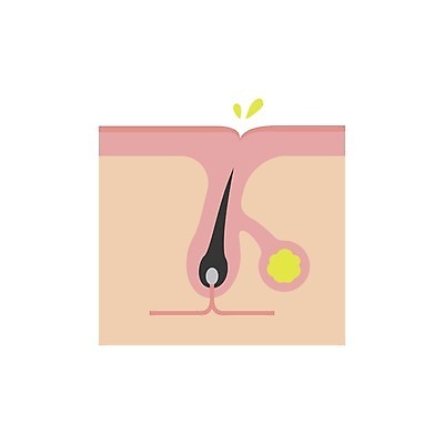 EPS 해외이미지 일러스트 의학 털 건강 사람없음 질병 피부 피부질환 모공 피부염 피부트러블 피지 피부층 해외일러스트 신체부위 파일형식 벡터 이미지허브