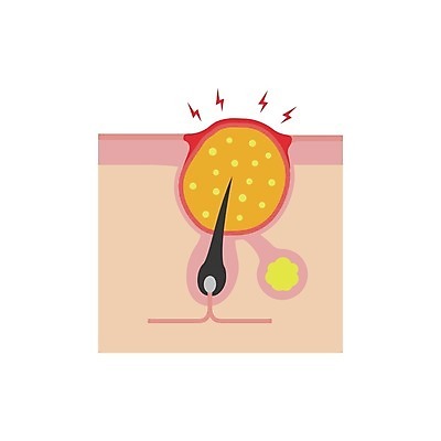 EPS 해외이미지 일러스트 의학 털 건강 사람없음 질병 피부 고름 여드름 피부질환 모공 피부병 피부염 피부층 해외일러스트 신체부위 파일형식 벡터 이미지허브