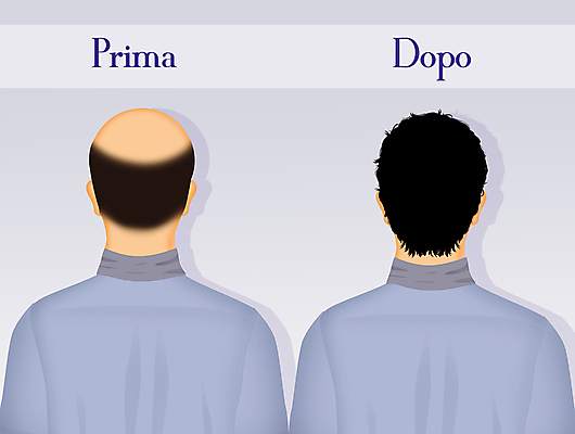 포토 JPG 해외이미지 남자 일러스트 세포 매달리기 사람없음 치료 머리 가을 대머리 해결 이마 증상 노화 해외일러스트 헤어스타일 계절 컨셉 의학 모션 사람 신체부위 파일형식 이미지허브
