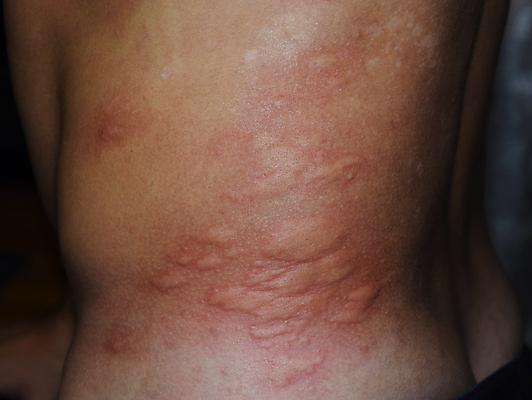 포토 JPG 해외이미지 분홍색 곤충 표면 건조 건강 육류 사람 성인 사람없음 옆모습 빨간색 약 고통 짜증 점 원형 닫기 질병 상처 위험 무서움 피부 묘사 어깨 전염 목 보여주기 알레르기 두드러기 돌봄 반응 염증 주목 증상 해외포토 도형 동물 감정 뷰포인트 컬러 컨셉 식재료 의학 모션 신체부위 감염 파일형식 이미지허브